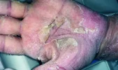 skin desquamation.webp